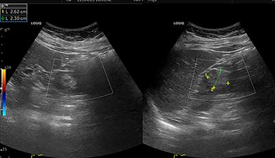 Rare papillary renal neoplasm with reverse polarity: A case report and review of the literature